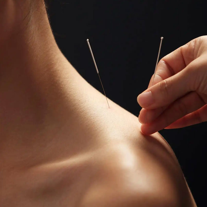 What is Acupuncture and Moxibustion?