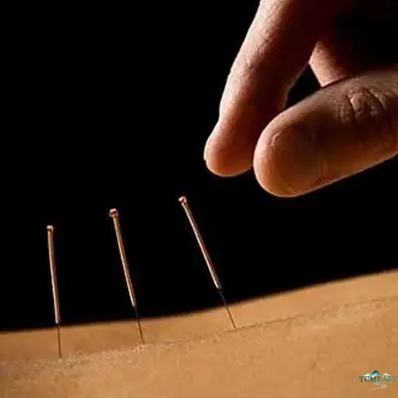 Chinese Medicine for Pain Management: Acupuncture Points, Herbs & Natural Relief